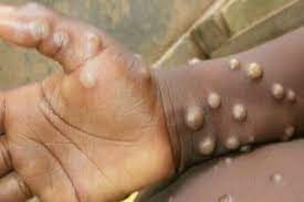 No Monkey pox in Malawi