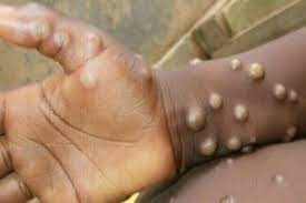 No Monkey pox in Malawi No Monkey pox in Malawi