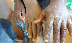 Machinga records over 200 Scabies cases Machinga records over 200 Scabies cases