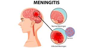 Trial on new Cryptococcal Meningitis Treatment in Malawi, Tanzania rolls out
