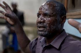 Ministry of Health declares outbreak of Mpox disease in Lilongwe Ministry of Health declares outbreak of Mpox disease in Lilongwe
