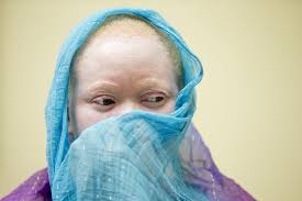 UN Expert in Malawi to  assess abuses on albinism