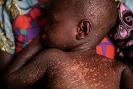 Ministry records 123 cases of measles, one death in Mangochi Ministry records 123 cases of measles, one death in Mangochi